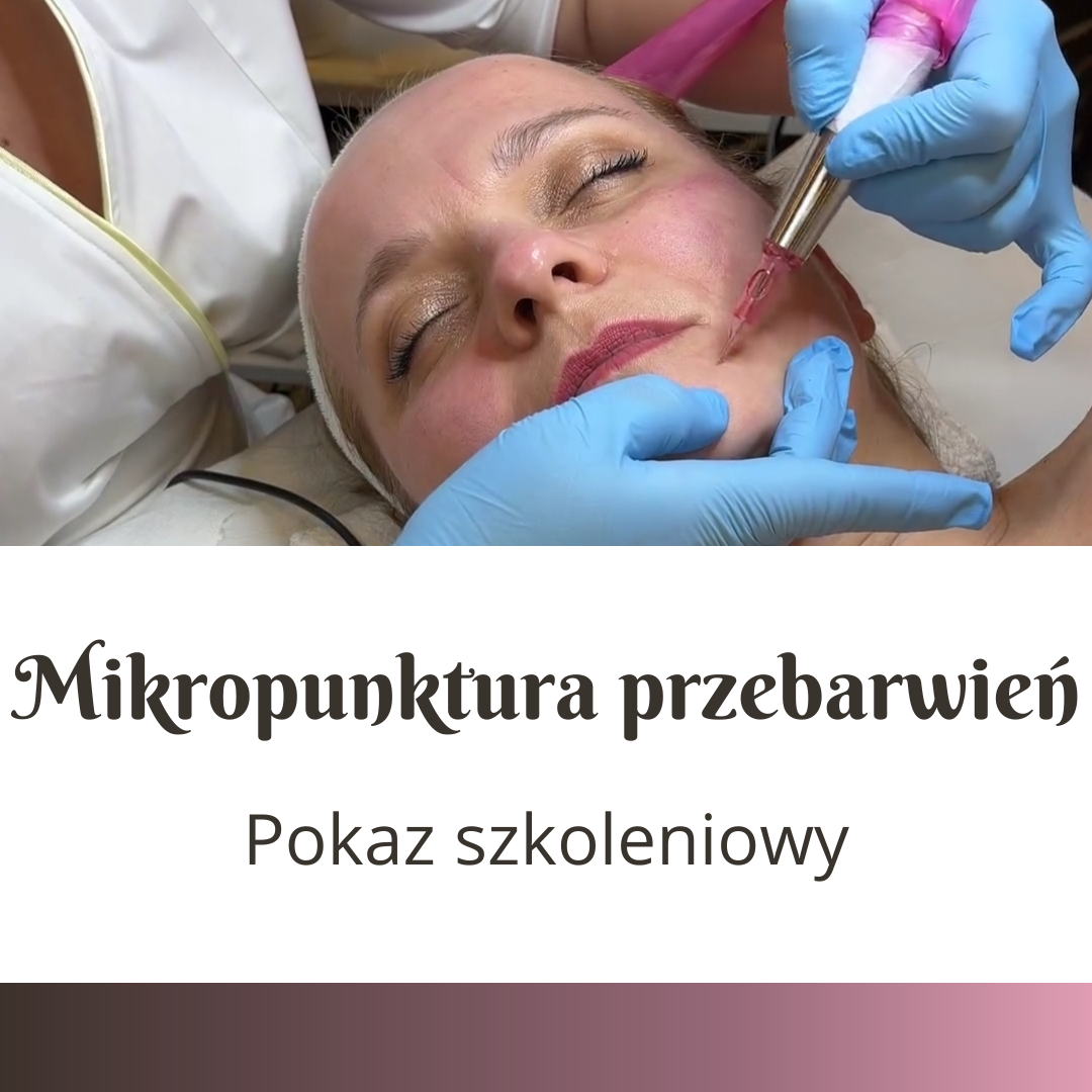 Mikropunktura przebarwień
